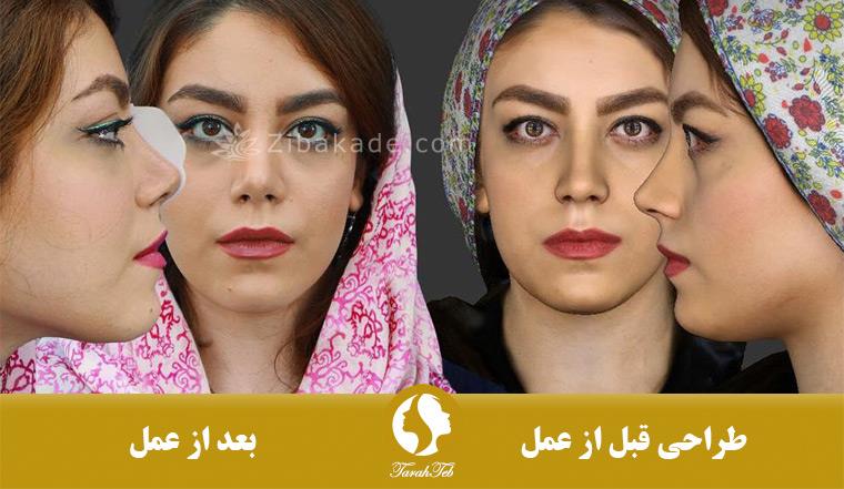 انحراف بینی 